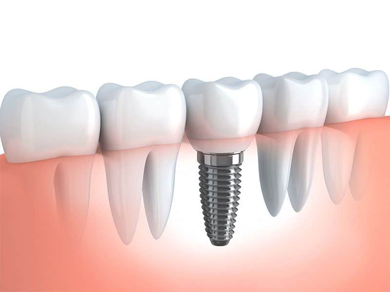 Root canal vs. Dental Implant