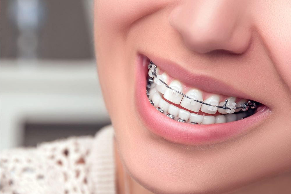 orthodontics-braces