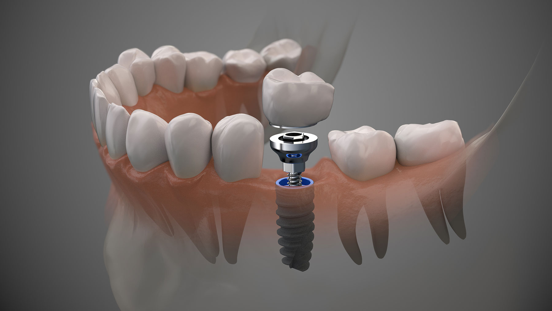 3D rendering of how a dental implant is inserted into the gumline.