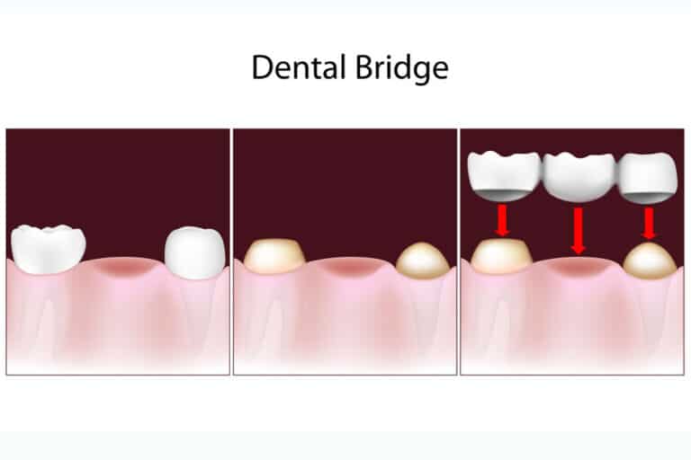 dental bridges in San Clemente