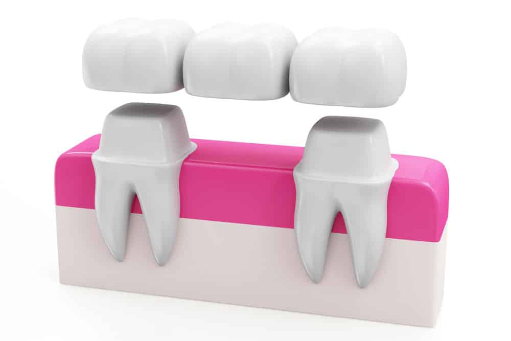Before and after transformation of missing teeth replaced with a custom dental bridge at Smile Design Dental Group