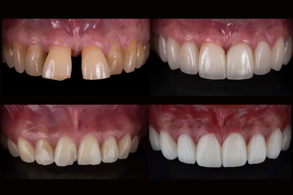 Side-by-side comparison of a smile transformation using porcelain veneers at Smile Design Dental Group in San Clemente
