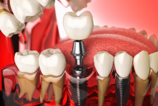 Dental Implants in San Clemente
