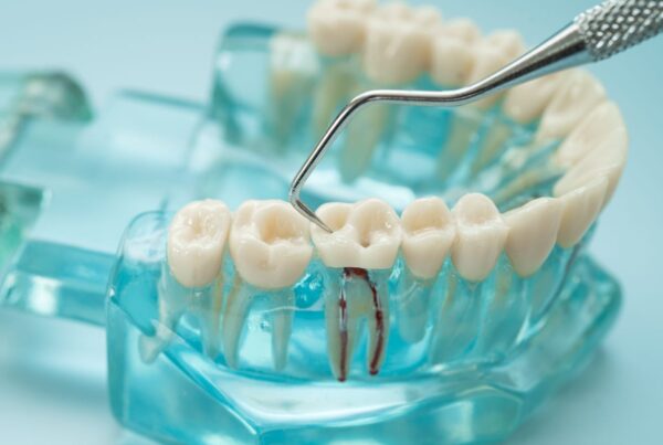 Root Canal Treatment in San Clemente